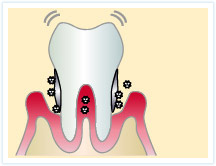 中程度の歯周病